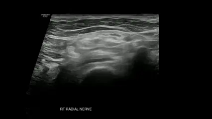 Baseball elbow